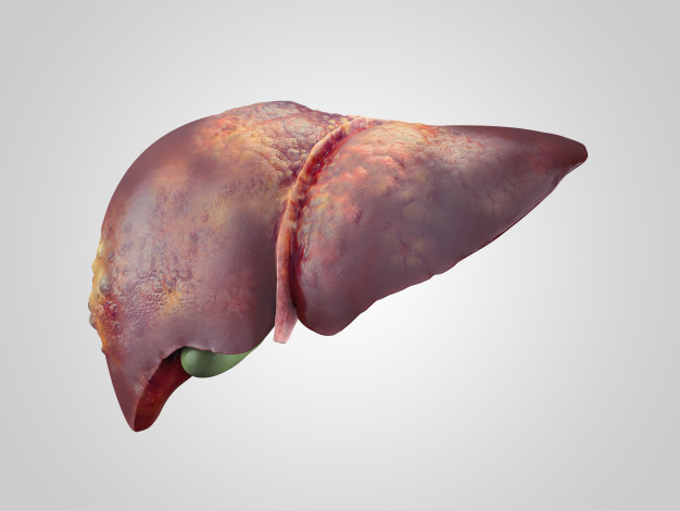 pcos fatty liver diet